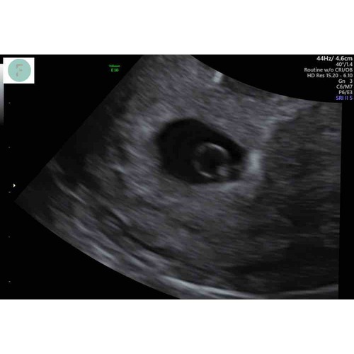 Echo 5 Weken Iemand Een Voorbeeld Zwangerschapspraat 1 24baby 