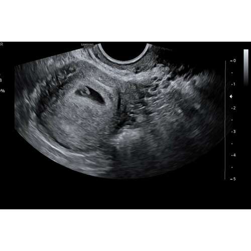 Echo 5 Weken Iemand Een Voorbeeld Zwangerschapspraat 1 24baby Echo 5 Weken Iemand Een Voorbeeld Zwangerschapspraat 1 24baby