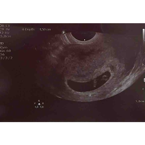6 weken echo nog amper vruchtje miskraam 1 24baby Forum