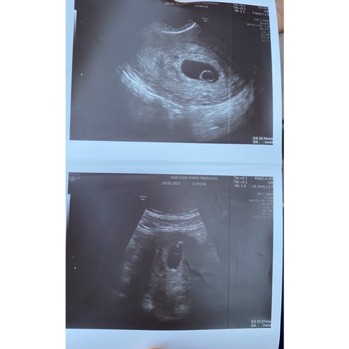 Vruchtzakje+dooier geen vruchtje 6 weken en 4 dagen zwangerschapspraat 1 24baby Forum