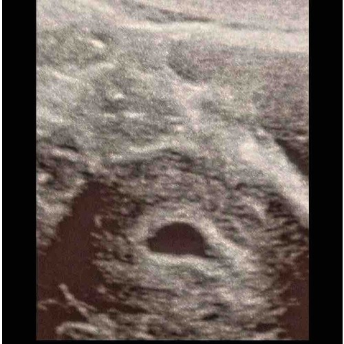 5 weken en 6 dagen echo, alleen een heel klein bolletje te zien?! miskraam 1 24Baby Forum