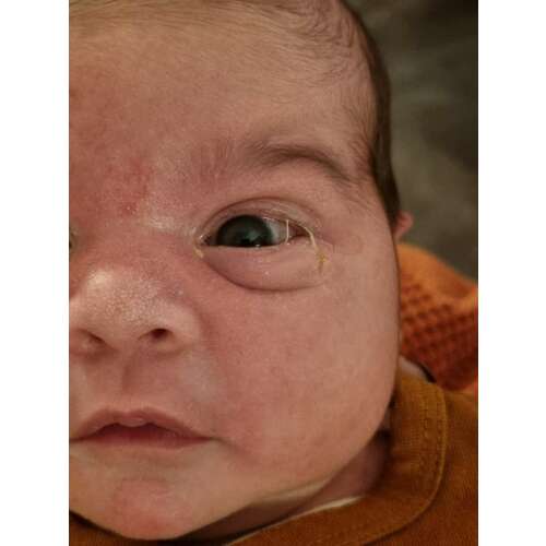 Ontstoken oog bij je baby: ernstig of niet?