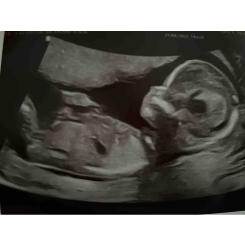 Geslacht 13 weken echo? 1 24baby Forum