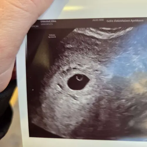 Iemand Een Echo Van 5 Weken En 3 Dagen 1 24baby Forum