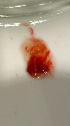 Diarree: niet altijd zo onschuldig