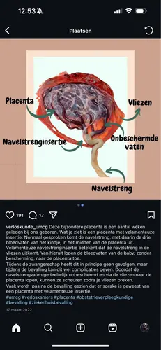 Velamenteuze insertie navelstreng | 1 | 24baby Forum