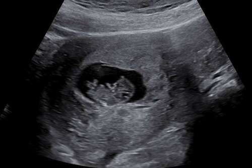 Weer helder rood bloed. | 1 | 24baby Forum